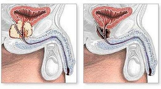 Surgical before and after the treatment of chronic prostatitis