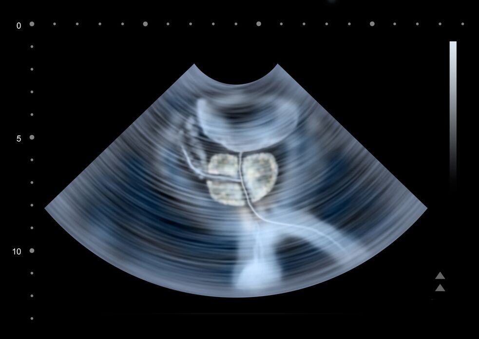 prostate diagnostics