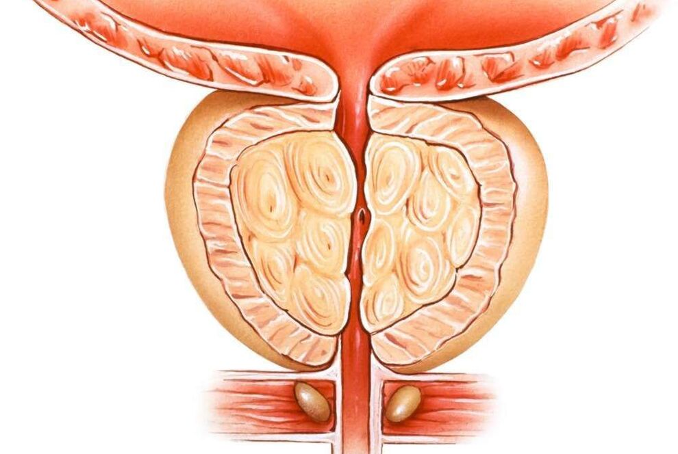 stasis prostatitis