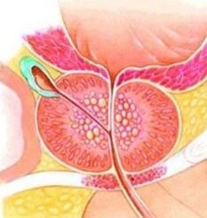 Prostate -adenom
